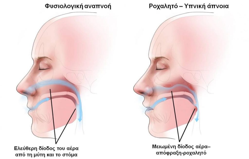 Δημοτικά ιατρεία
Παγκόσμια ημέρα Υγείας
Χρόνιο Ροχαλητο
Εκατοντάδες χιλιάδες άνθρωποι,κυρίως άντρες αλλά και γυναίκες ταλαιπωρούνται από το ροχαλητό και τις τραγικές του συνέπειες.Το χειρότερο όμως είναι ότι οι περισσότεροι έχουν συμβιβαστεί με αυτό….